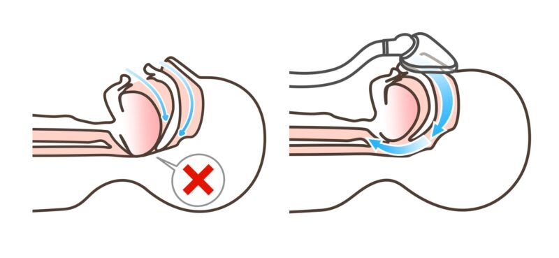 CPAP療法（経鼻的持続陽圧呼吸療法）