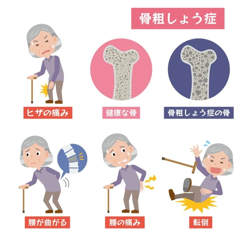 骨粗しょう症（骨粗鬆症）